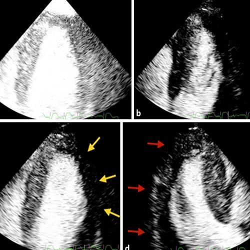 Contrast echocardiography