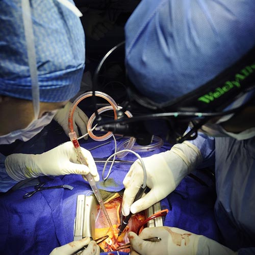 Heart failure treatment