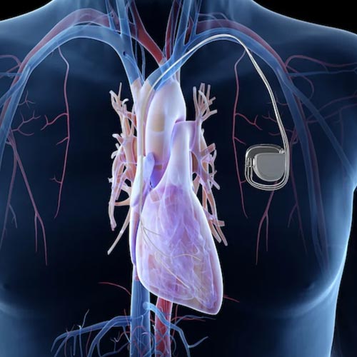 Implantable loop recorder (ILR)