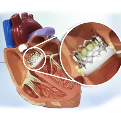 Transcatheter aortic valve implantation (TAVI)