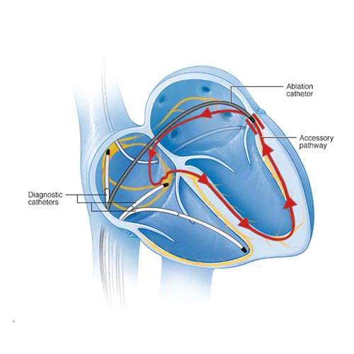 Cardiac arrhythmia treatment